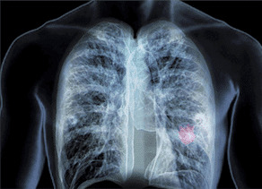 Lung Cancer, LPC, Colon Cancer